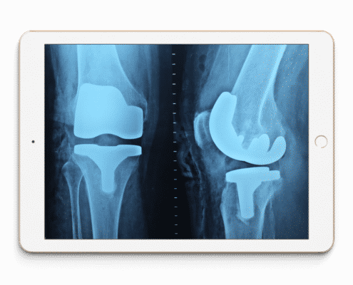 Radiographie médicale illustrant un préjudice corporel et une expertise médicale