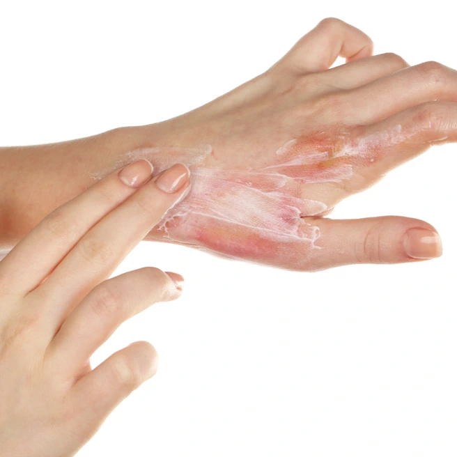 Main présentant une brûlure cutanée en cours de soin avec application de crème.